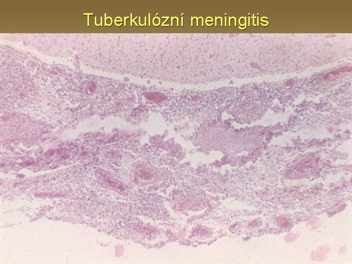 Tuberkulózní meningitis 