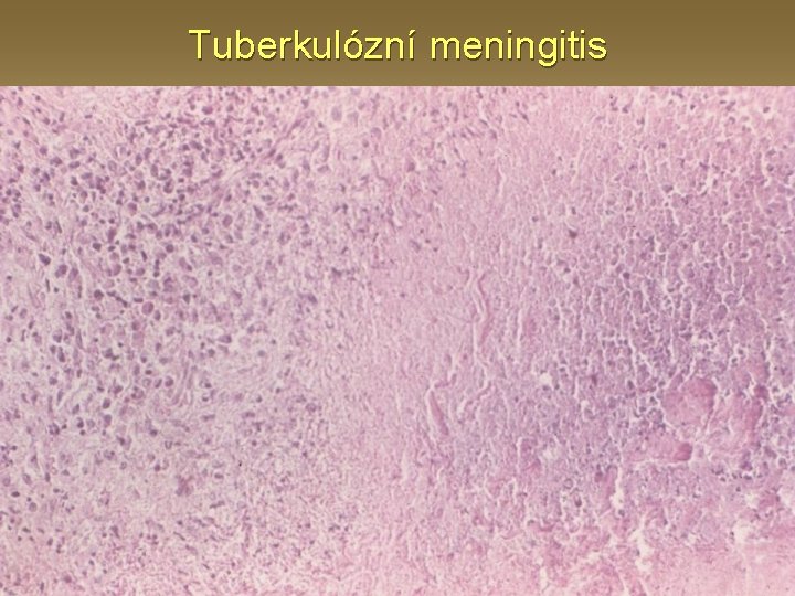 Tuberkulózní meningitis 