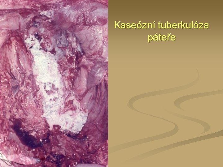 Kaseózní tuberkulóza páteře 