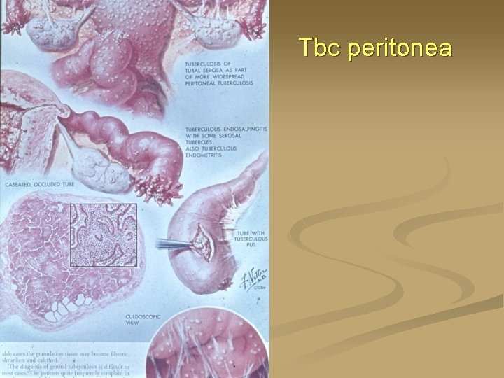 Tbc peritonea 