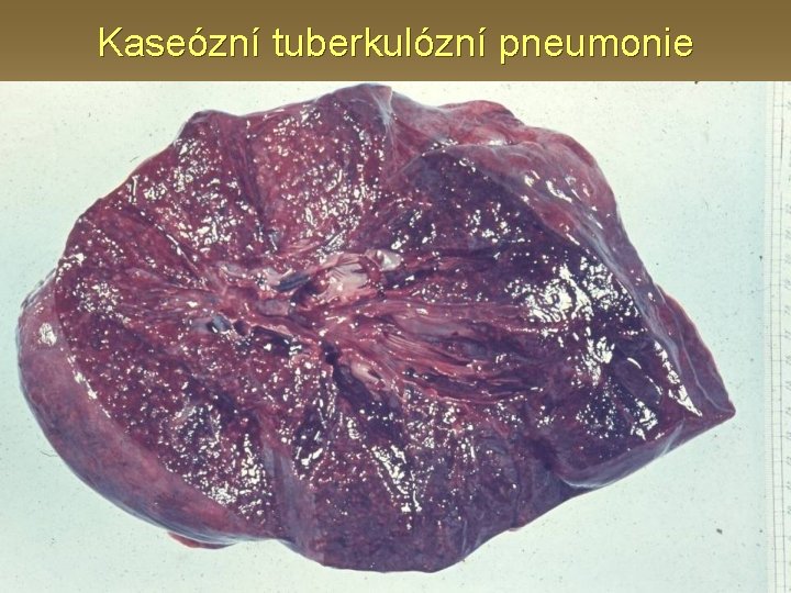 Kaseózní tuberkulózní pneumonie 