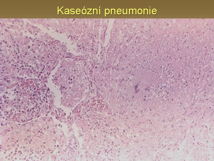 Kaseózní pneumonie 