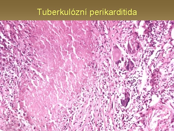 Tuberkulózní perikarditida 