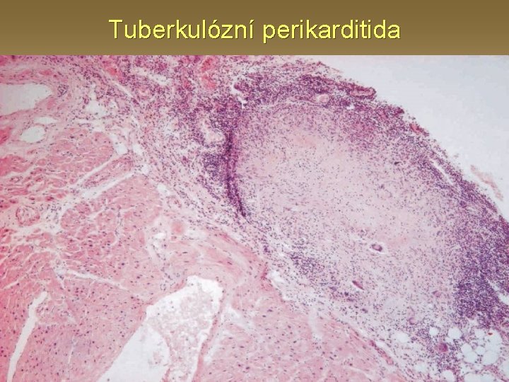Tuberkulózní perikarditida 