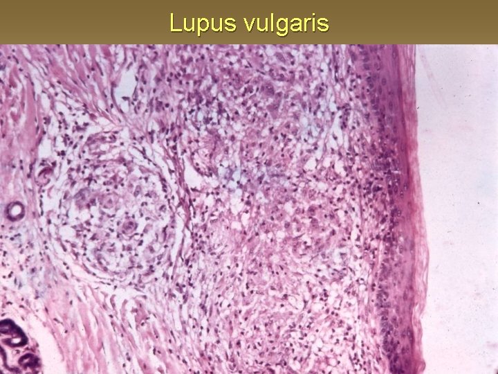 Lupus vulgaris 