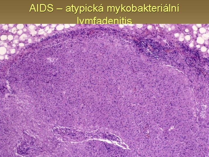 AIDS – atypická mykobakteriální lymfadenitis 