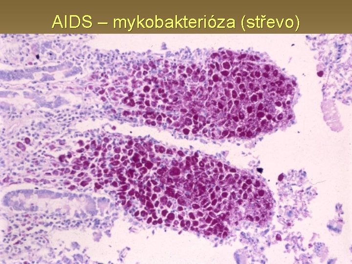 AIDS – mykobakterióza (střevo) 