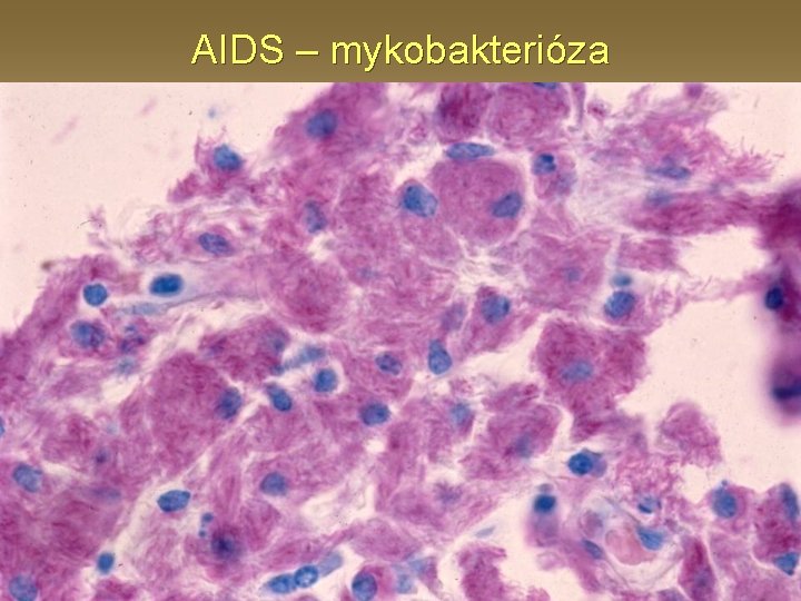 AIDS – mykobakterióza 
