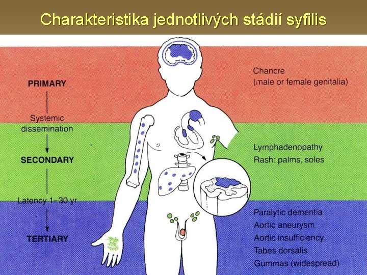 Charakteristika jednotlivých stádií syfilis 