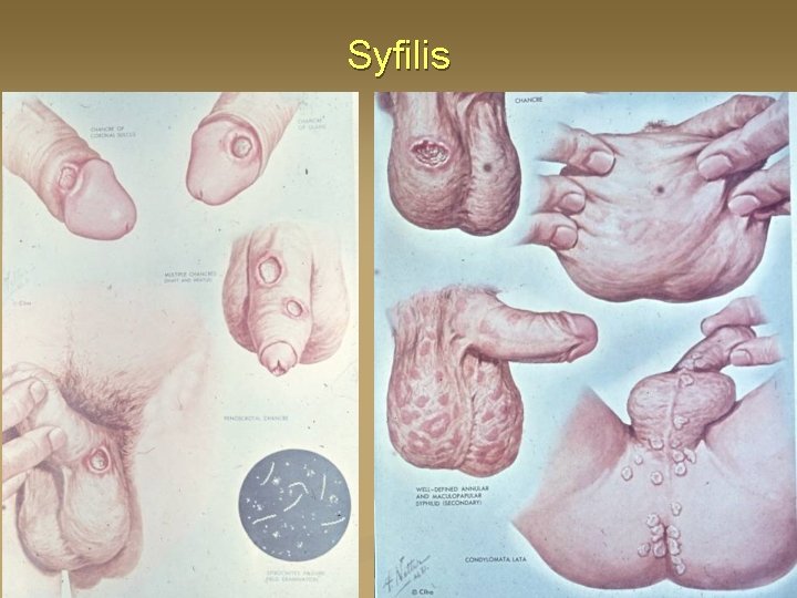 Syfilis 