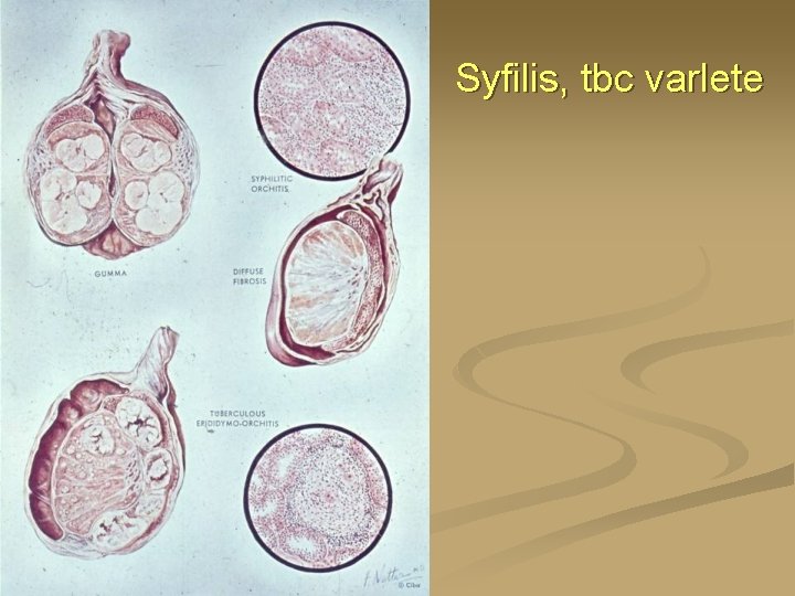 Syfilis, tbc varlete 