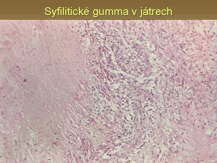 Syfilitické gumma v játrech 