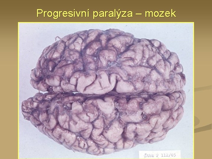 Progresivní paralýza – mozek 