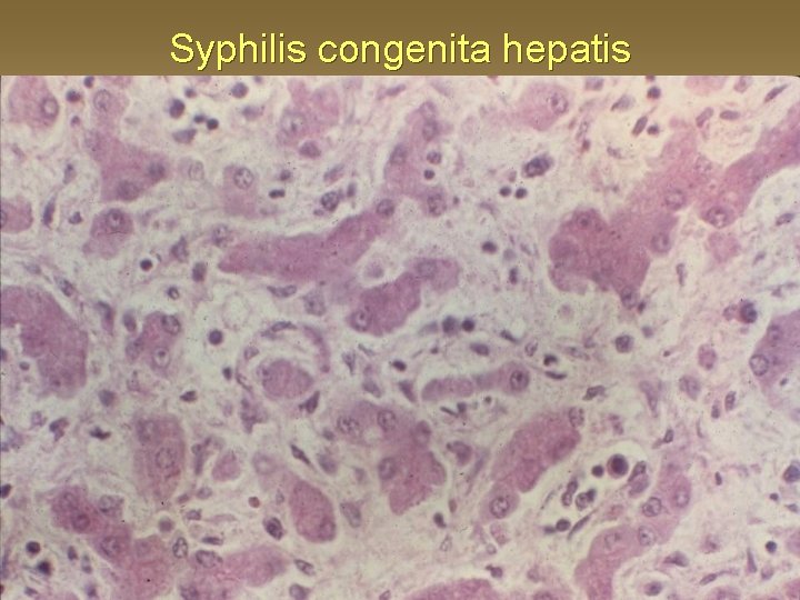 Syphilis congenita hepatis 