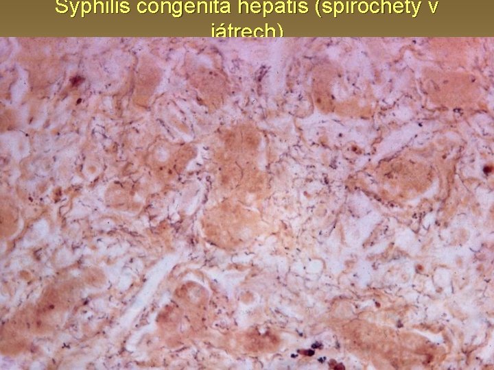 Syphilis congenita hepatis (spirochety v játrech) 