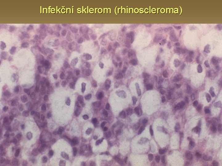 Infekční sklerom (rhinoscleroma) 