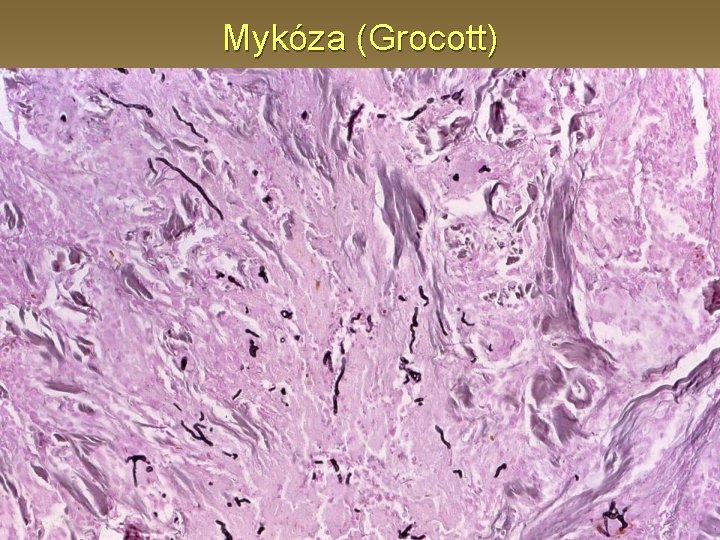 Mykóza (Grocott) 