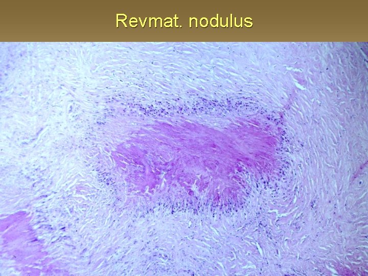 Revmat. nodulus 