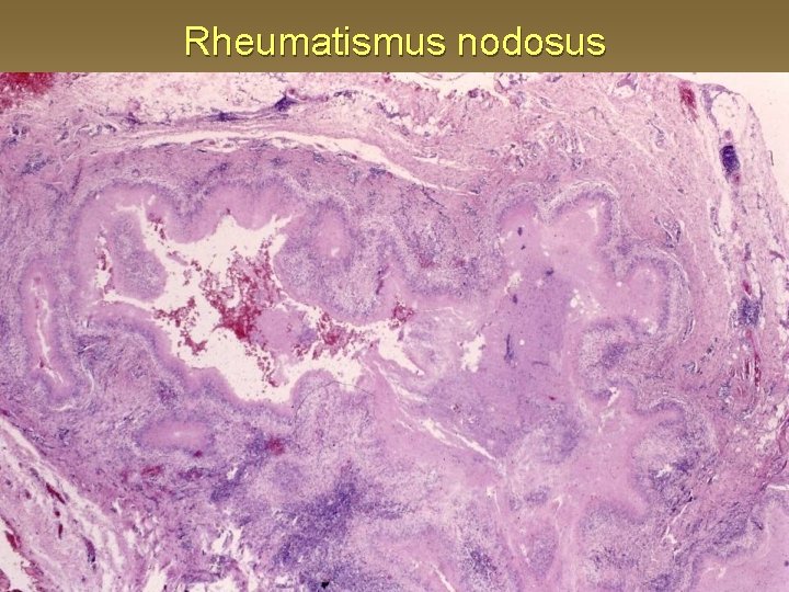 Rheumatismus nodosus 