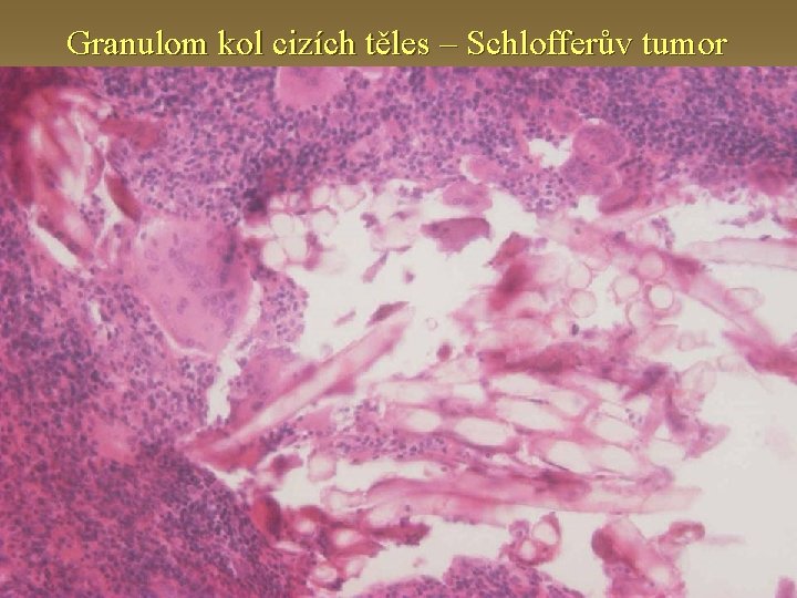 Granulom kol cizích těles – Schlofferův tumor 