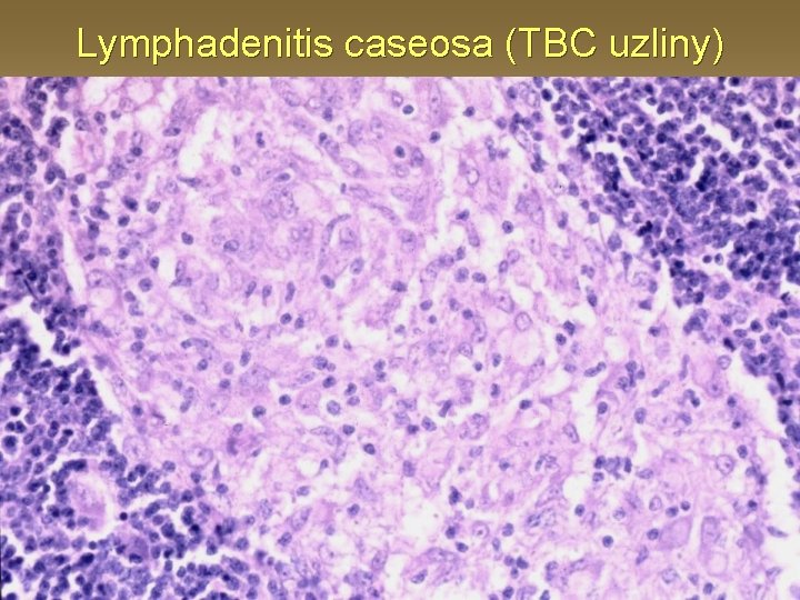 Lymphadenitis caseosa (TBC uzliny) 