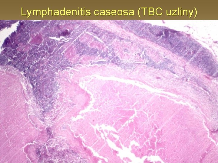 Lymphadenitis caseosa (TBC uzliny) 