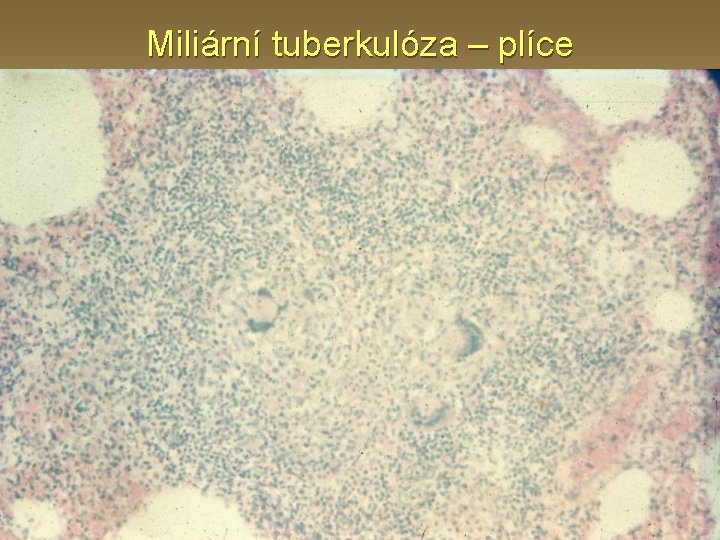 Miliární tuberkulóza – plíce 