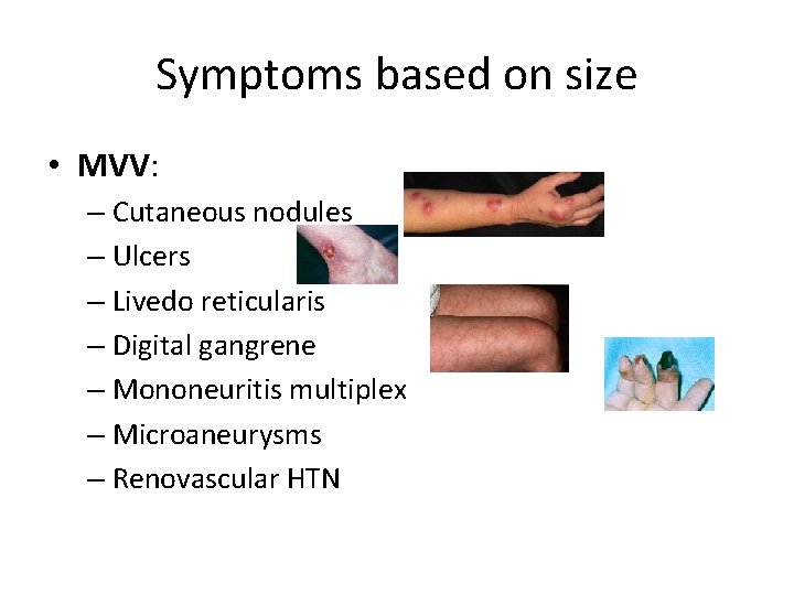 Symptoms based on size • MVV: – Cutaneous nodules – Ulcers – Livedo reticularis