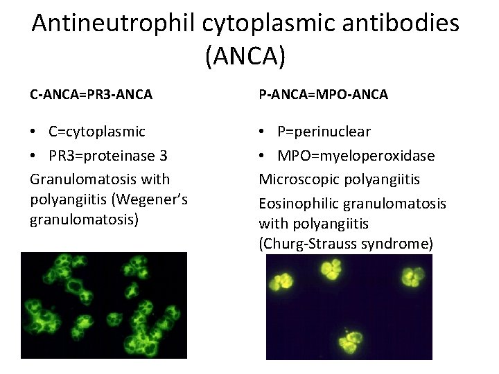 Antineutrophil cytoplasmic antibodies (ANCA) C‐ANCA=PR 3‐ANCA P‐ANCA=MPO‐ANCA • C=cytoplasmic • PR 3=proteinase 3 Granulomatosis