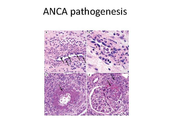 ANCA pathogenesis 