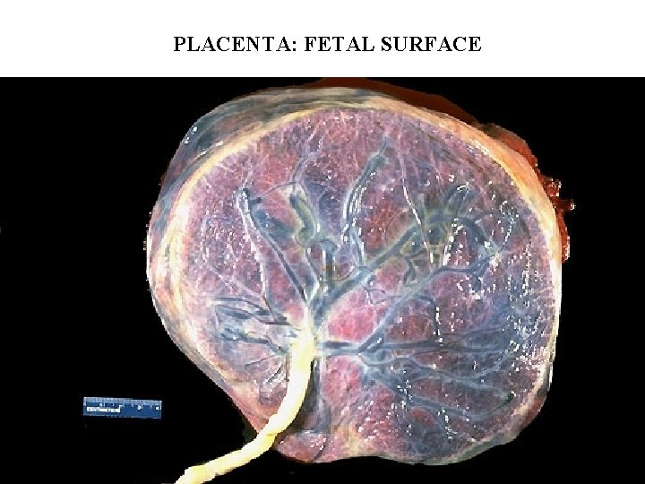 PLACENTA: FETAL SURFACE 