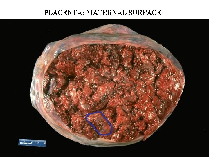 PLACENTA: MATERNAL SURFACE 