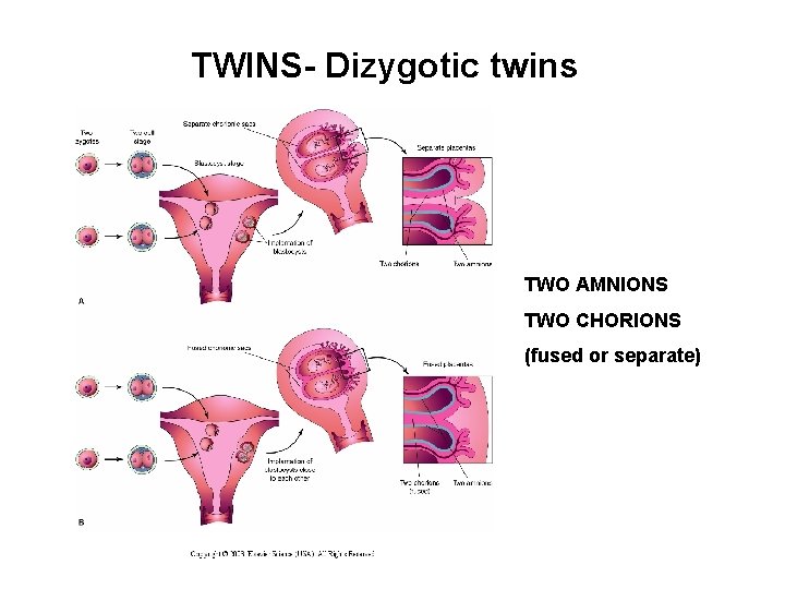 TWINS- Dizygotic twins TWO AMNIONS TWO CHORIONS (fused or separate) 
