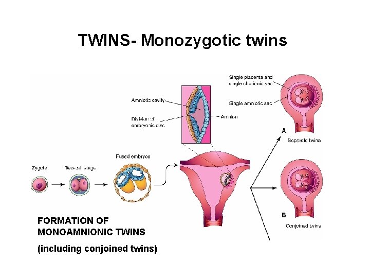 TWINS- Monozygotic twins FORMATION OF MONOAMNIONIC TWINS (including conjoined twins) 