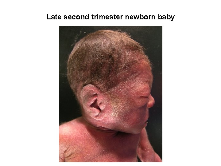 Late second trimester newborn baby 