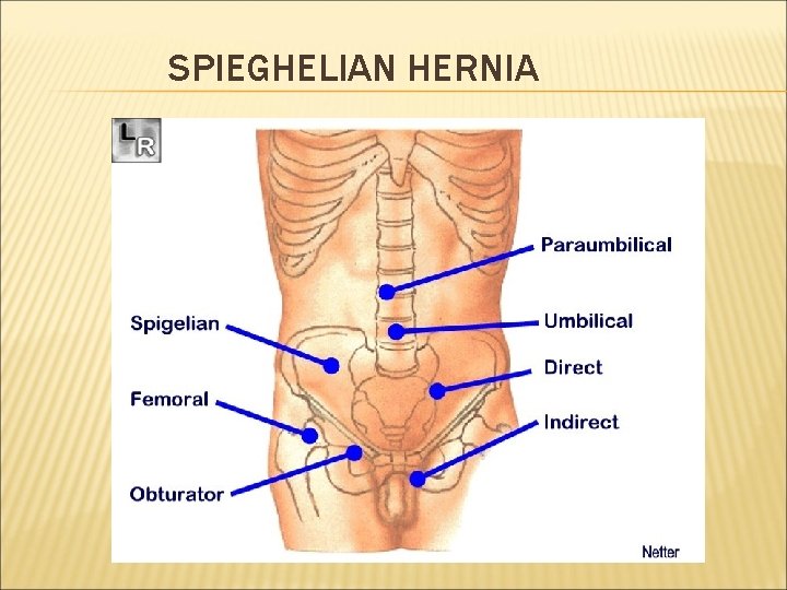 SPIEGHELIAN HERNIA 