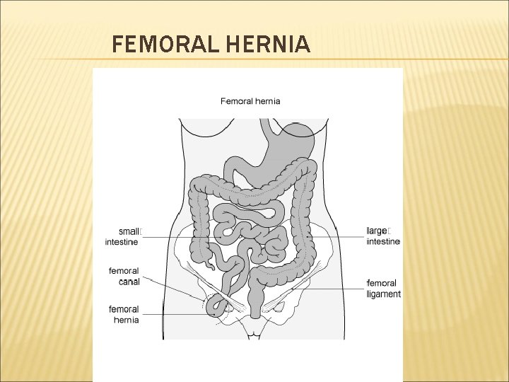 FEMORAL HERNIA 