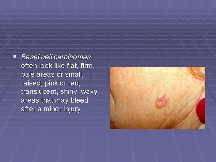  Basal cell carcinomas often look like flat, firm, pale areas or small, raised,