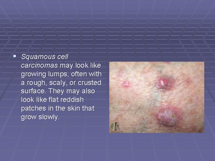  Squamous cell carcinomas may look like growing lumps, often with a rough, scaly,