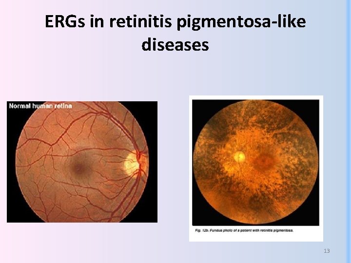 ERGs in retinitis pigmentosa-like diseases 13 