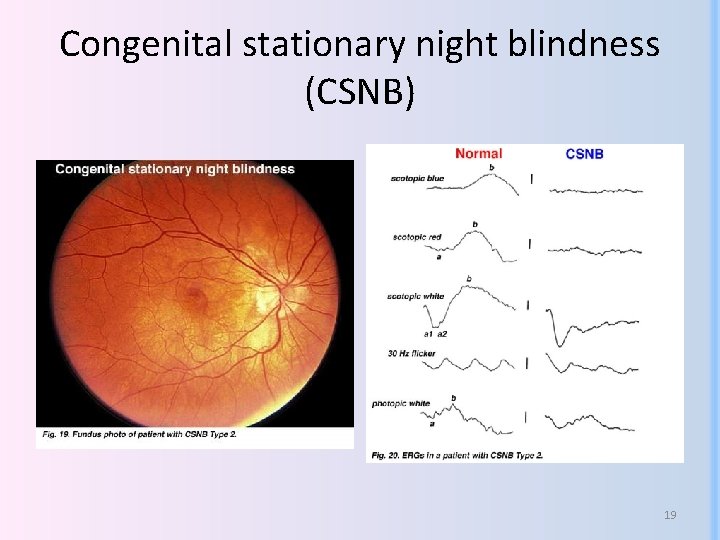 Congenital stationary night blindness (CSNB) 19 Congenital stationary night blindness (CSNB) 19