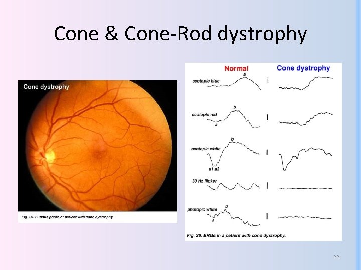 Cone & Cone-Rod dystrophy 22 