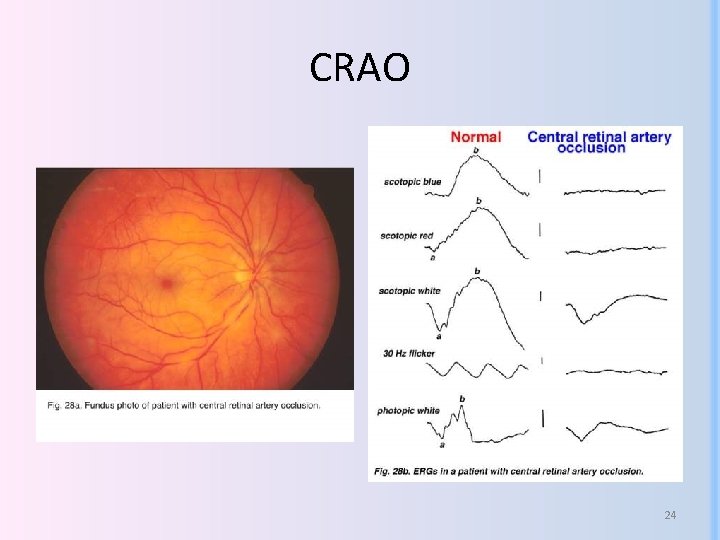 CRAO 24 