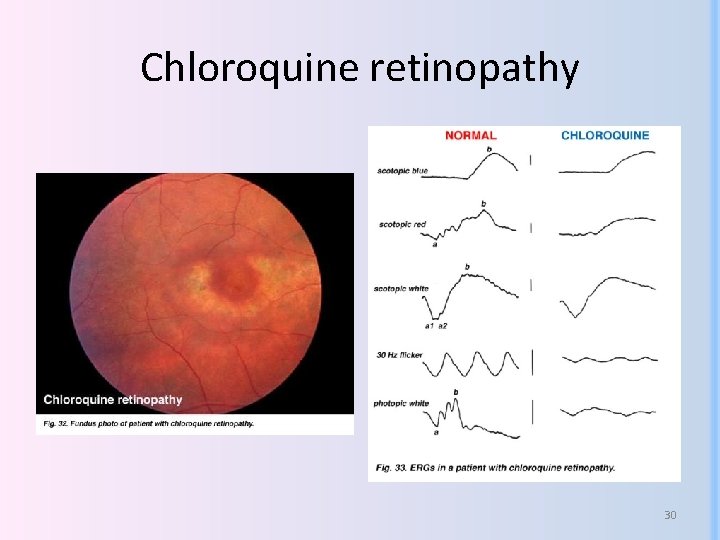 Chloroquine retinopathy 30 