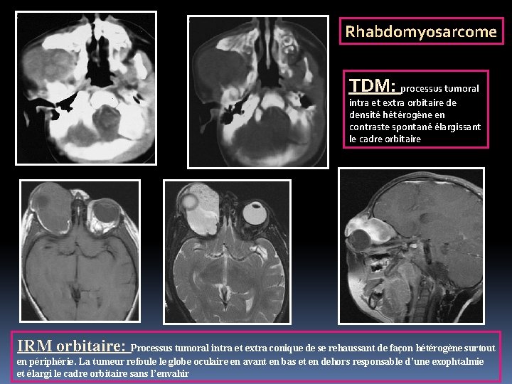 Rhabdomyosarcome TDM: processus tumoral intra et extra orbitaire de densité hétérogène en contraste spontané