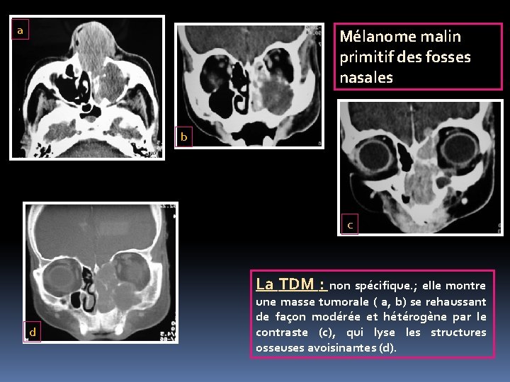 a Mélanome malin primitif des fosses nasales b c La TDM : non spécifique.