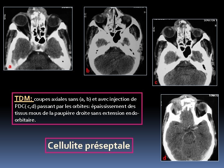 a b c TDM: coupes axiales sans (a, b) et avec injection de PDC(