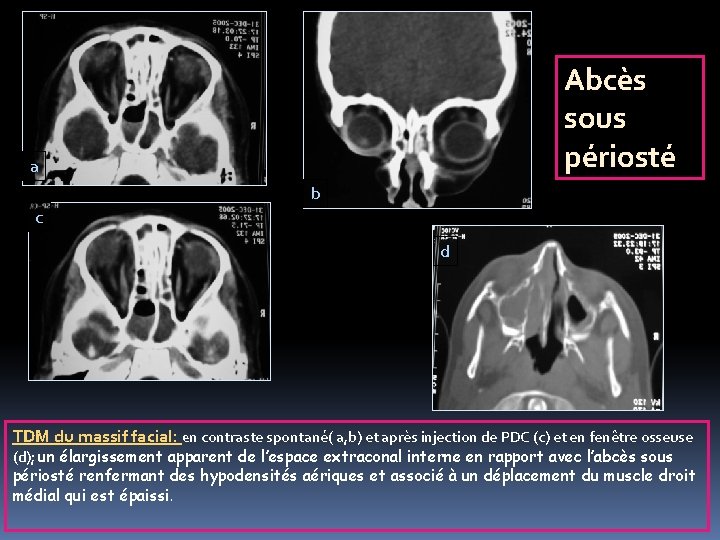 Abcès sous périosté a b c d TDM du massif facial: en contraste spontané(