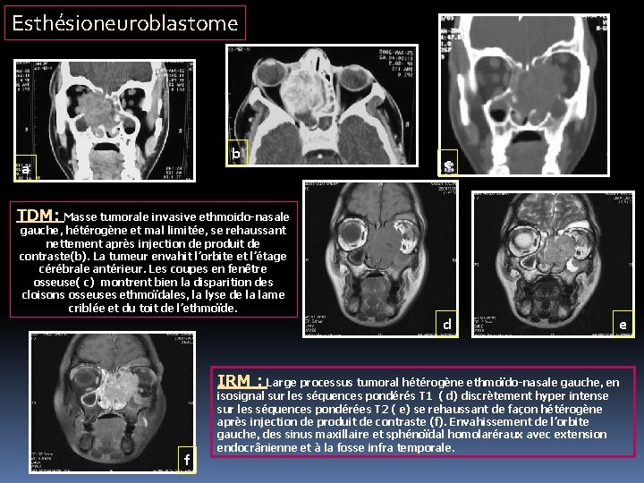 Esthésioneuroblastome b a c TDM: Masse tumorale invasive ethmoido-nasale gauche, hétérogène et mal limitée,