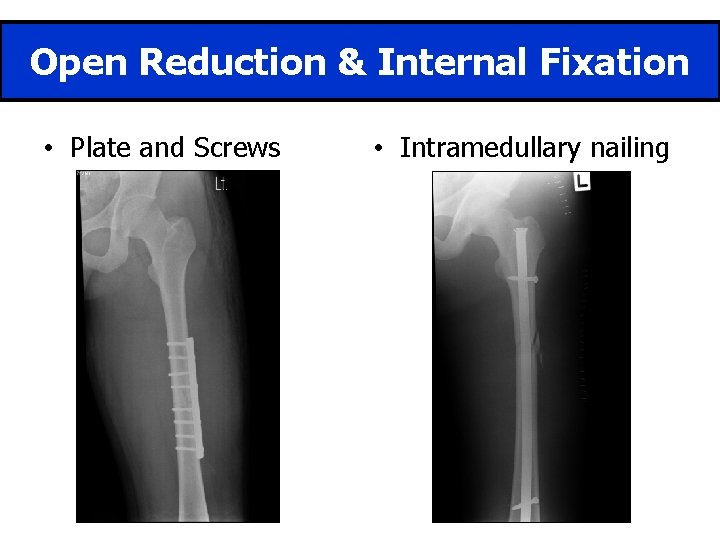 Open Reduction & Internal Fixation • Plate and Screws • Intramedullary nailing 